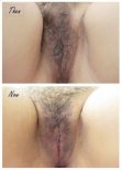 Before and after labiaplasty results at Asia Cosmetic Hospital, improved labia appearance