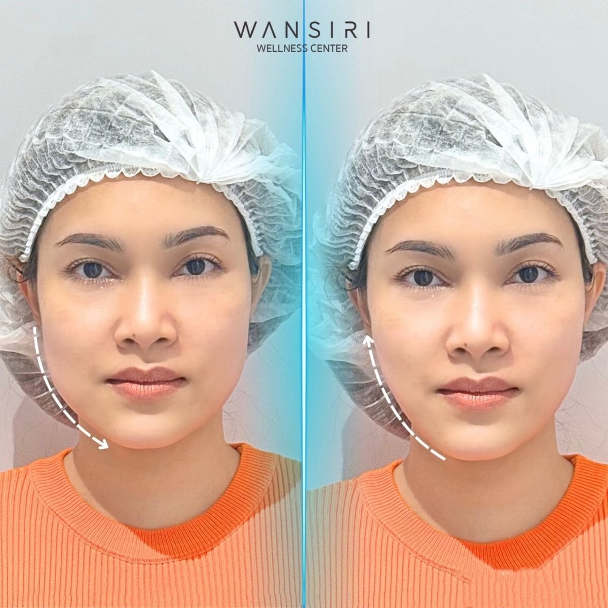Resultados de Ultherapy antes y después en Wansiri Hospital – contorno facial más firme