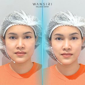 Результаты до и после Ultherapy в Wansiri Hospital – видимое подтяжка контура лица