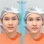 Результаты до и после Ultherapy в Wansiri Hospital – видимое подтяжка контура лица