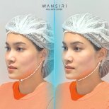 Результаты до и после ультерапии в Wansiri Hospital – видимый лифтинг линии подбородка
