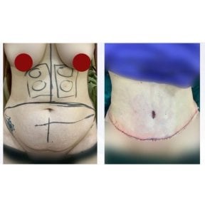 Результаты абдоминопластики до и после в DGB Clinic – плоский живот и улучшенный контур