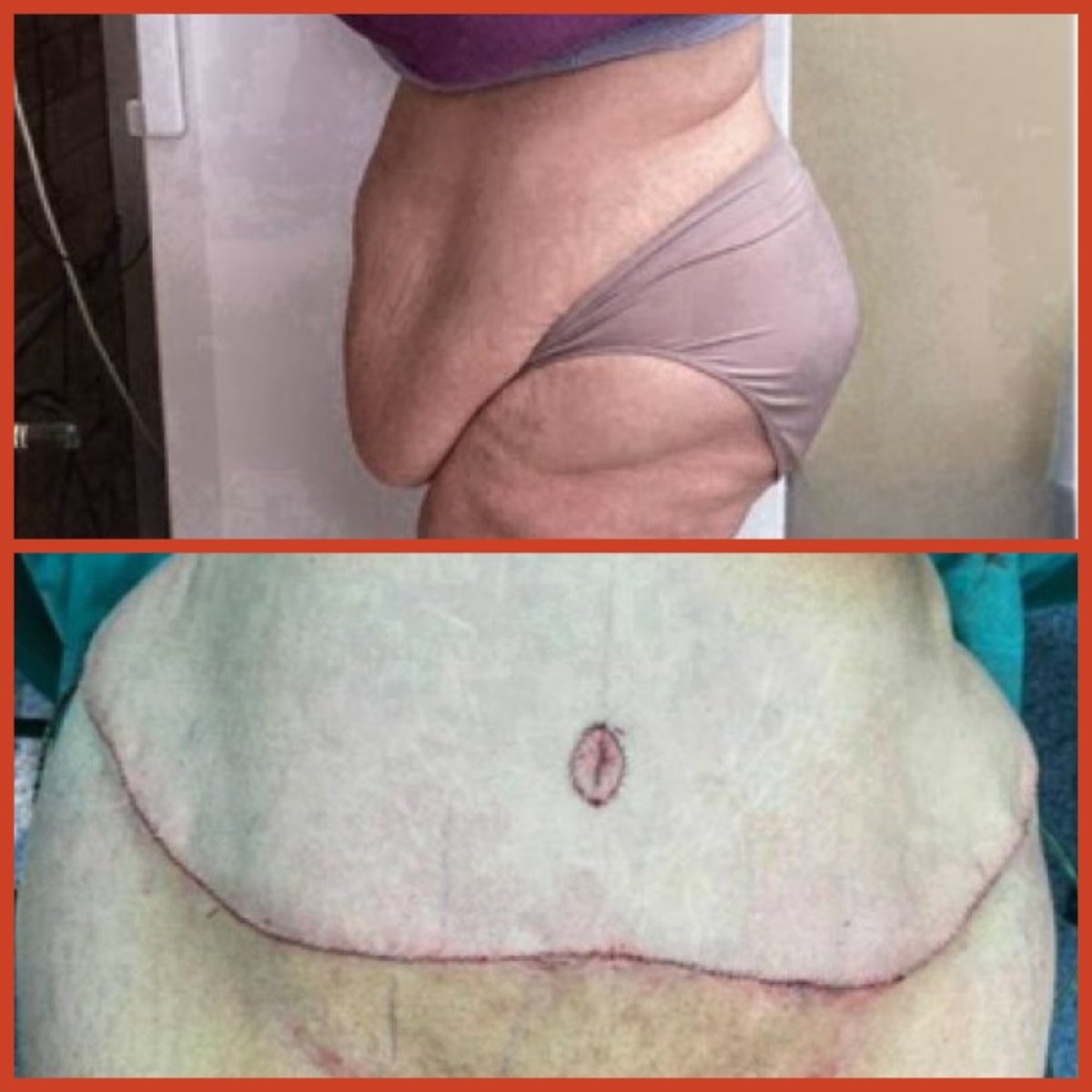 Vorher-nachher-Ergebnis Bauchdeckenstraffung bei DGB Clinic – verbesserte Bauchkontur