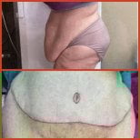 نتائج شد البطن قبل وبعد في DGB Clinic – تحسين شكل الجلد والبطن