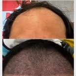 نتائج زراعة الشعر قبل وبعد في DGB Clinic – استعادة خط الشعر وكثافة فروة الرأس