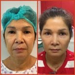 نتائج شد الوجه قبل وبعد في DGB Clinic، تجديد شباب الوجه وشد البشرة بوضوح