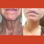 Before and after neck lift results at DGB Clinic – improved neck contour and tighter skin