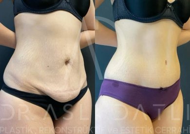 Vorher-nachher Renuvion J Plasma bei Liv Hospital Ulus, Ergebnis Bauchstraffung
