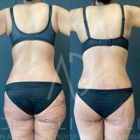 Vorher-nachher Renuvion J Plasma Body Contouring bei Liv Hospital Ulus, sichtbare Straffung