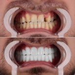 Vorher-nachher Veneers bei CE International Hospital – Ergebnis des Smile-Makeovers