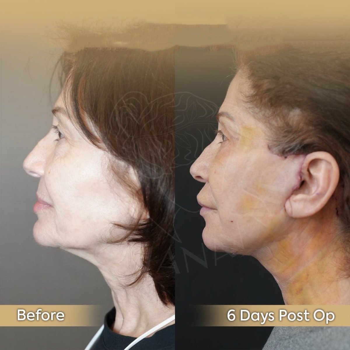 Resultados de lifting facial antes y después en Dr. Safa Manav Clinic, mejora de mandíbula y cuello