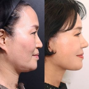 Before and after neck lift results at Returning Plastic Surgery, improved jawline definition