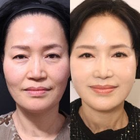 Before and after neck lift results at Returning Plastic Surgery, visible facial rejuvenation