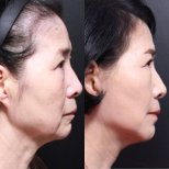 Before and after neck lift results at Returning Plastic Surgery, visible jawline tightening
