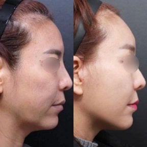 Before and after neck lift results at Returning Plastic Surgery, visible jawline improvement