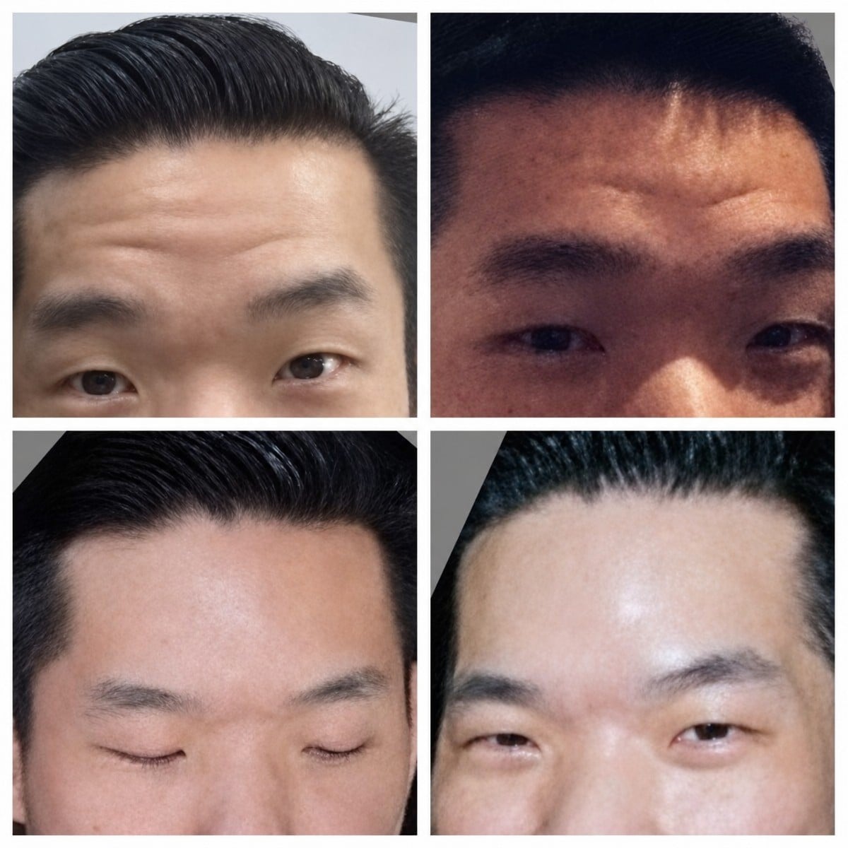 نتائج نقل دهون الوجه قبل وبعد في Asia Cosmetic Hospital، جبهة أكثر نعومة