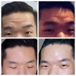 Before and after facial fat transfer results at Asia Cosmetic Hospital, smoother forehead appearance