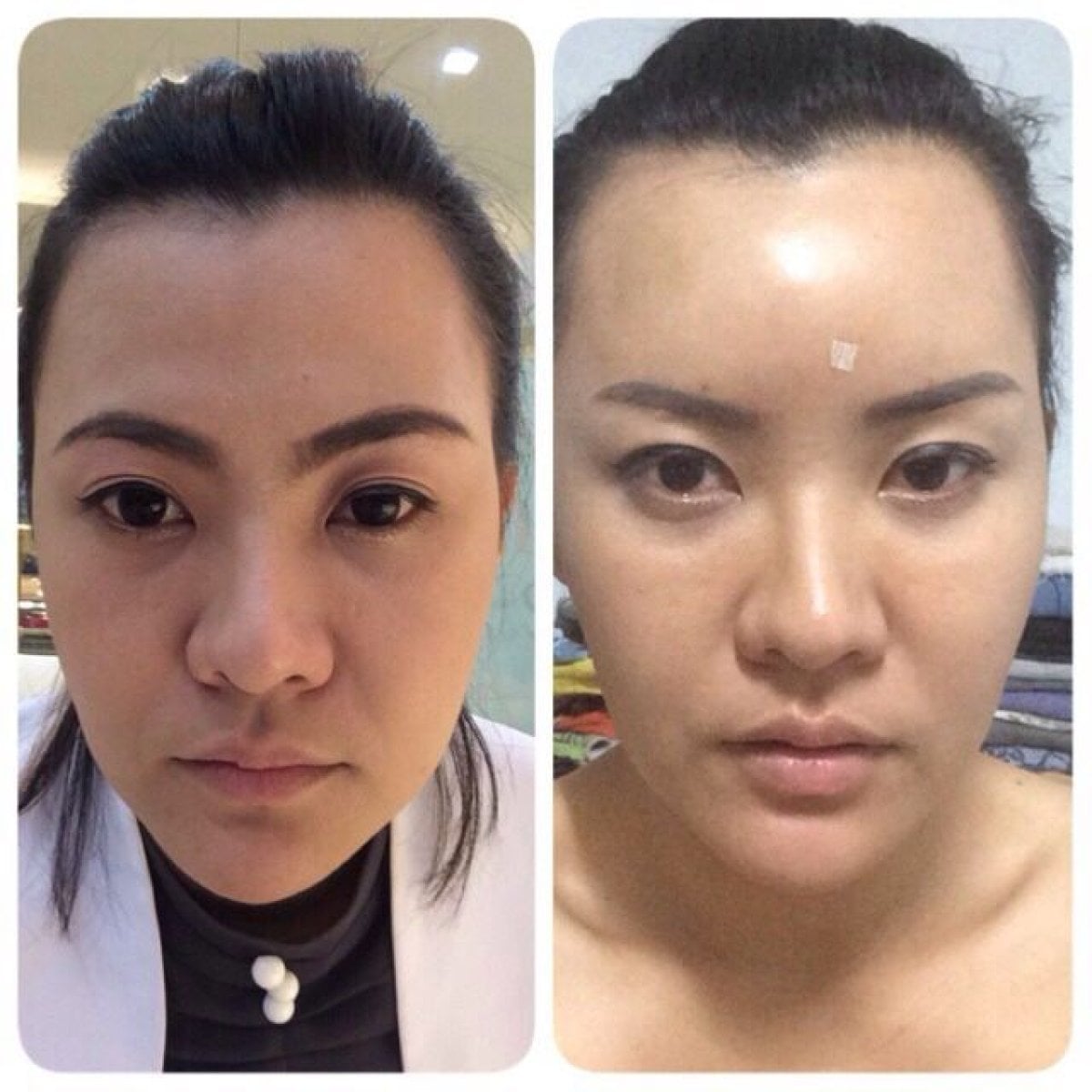 نتائج نقل دهون الوجه قبل وبعد في Asia Cosmetic Hospital، زيادة امتلاء الوجه
