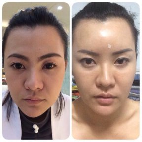 Before and after facial fat transfer results at Asia Cosmetic Hospital, enhanced facial volume
