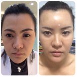 Before and after facial fat transfer results at Asia Cosmetic Hospital, enhanced facial volume