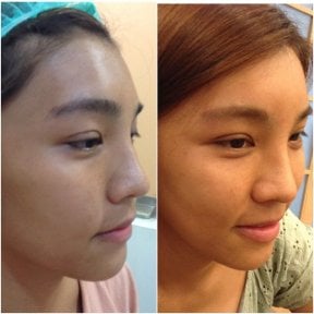 Before and after facial fat transfer results at Asia Cosmetic Hospital, enhanced facial volume