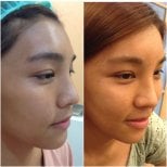 Before and after facial fat transfer results at Asia Cosmetic Hospital, enhanced facial volume