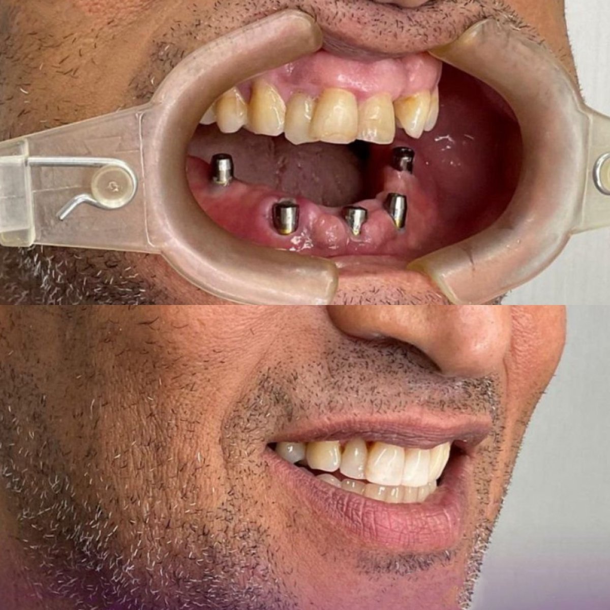 Resultados de implantes dentales antes y después en Paulino Almonte Dental Team, sonrisa restaurada
