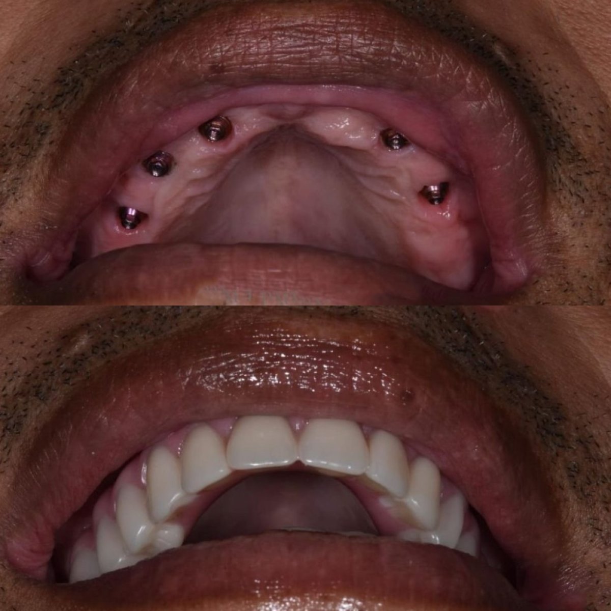 Resultados de implantes dentales antes y después en Paulino Almonte Dental Team, dientes superiores restaurados