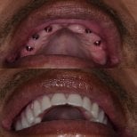 Resultados de implantes dentales antes y después en Paulino Almonte Dental Team, dientes superiores restaurados