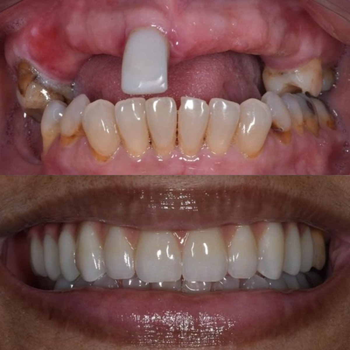 Resultados antes y después de implantes dentales en Paulino Almonte Dental Team, sonrisa restaurada