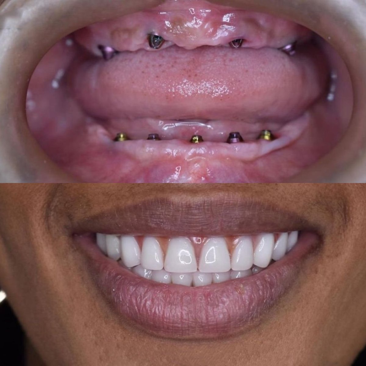 Before and after All-on-4 dental implants result at Paulino Almonte Dental Team, smile restored