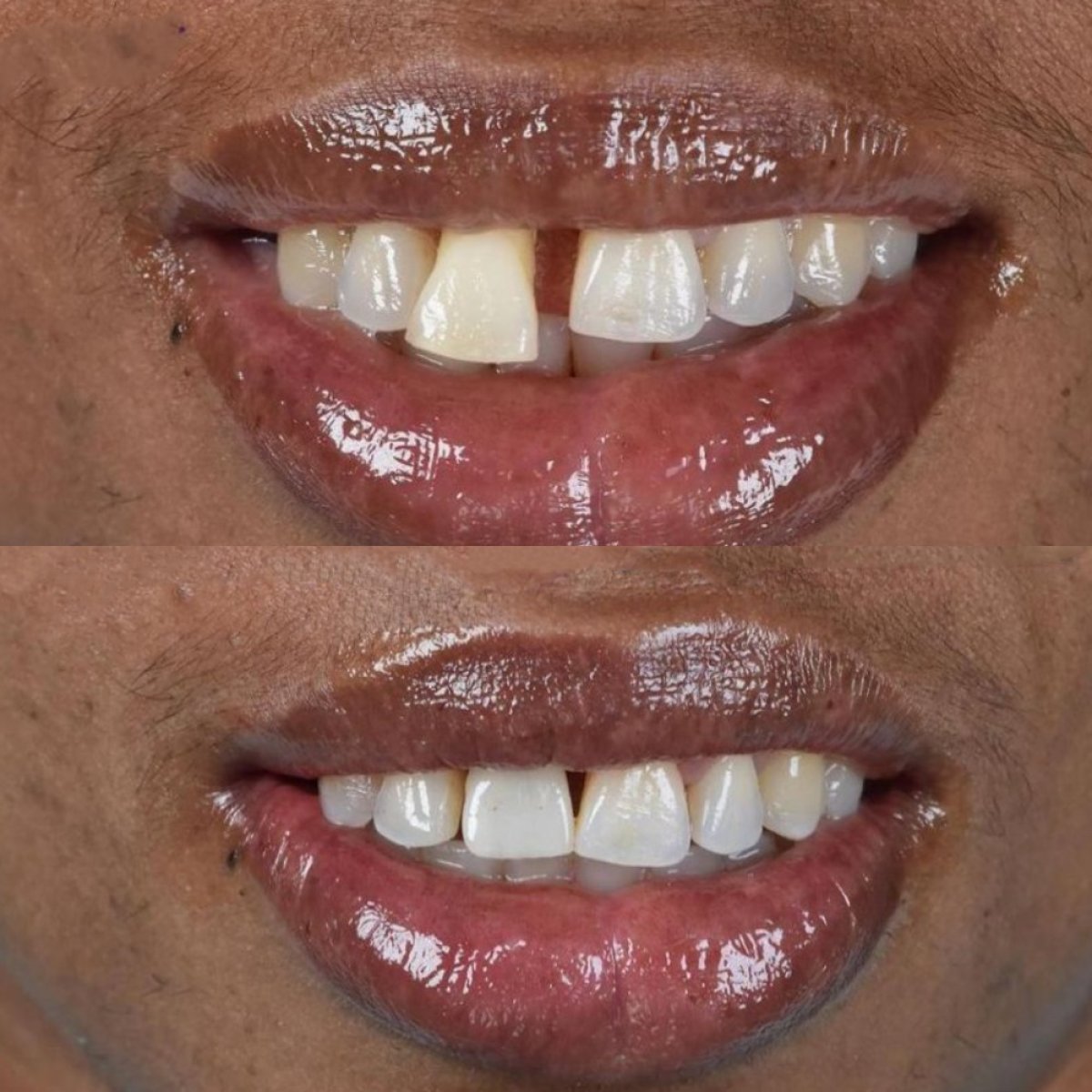 Before and after dental implant results at Paulino Almonte Dental Team, improved smile gap