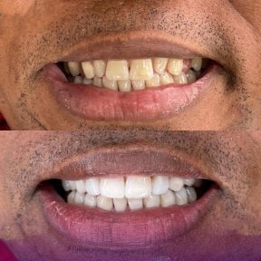 Resultado antes y después de carillas en Paulino Almonte Dental Team, transformación visible de la sonrisa
