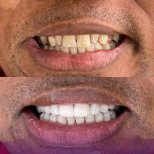 Resultado antes y después de carillas en Paulino Almonte Dental Team, transformación visible de la sonrisa