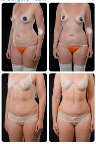 نتائج شد البطن وشفط الدهون قبل وبعد في Yurchenko Plastic Surgery Team Kyiv