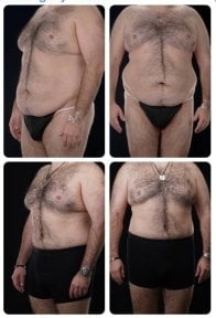 نتائج شد البطن وشفط الدهون قبل وبعد في Yurchenko Plastic Surgery Team Kyiv