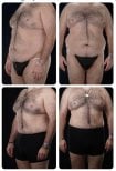 نتائج شد البطن وشفط الدهون قبل وبعد في Yurchenko Plastic Surgery Team Kyiv