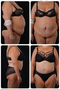 نتائج شد البطن وشفط الدهون قبل وبعد في Yurchenko Plastic Surgery Team Kyiv