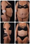 نتائج شد البطن وشفط الدهون قبل وبعد في Yurchenko Plastic Surgery Team Kyiv
