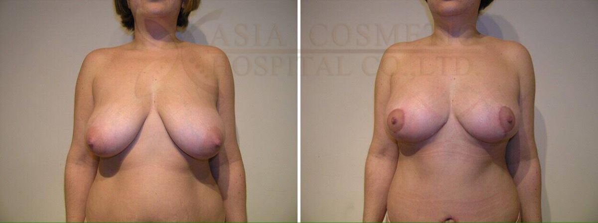 Before and after breast implant removal results at Asia Cosmetic Hospital, improved breast contour