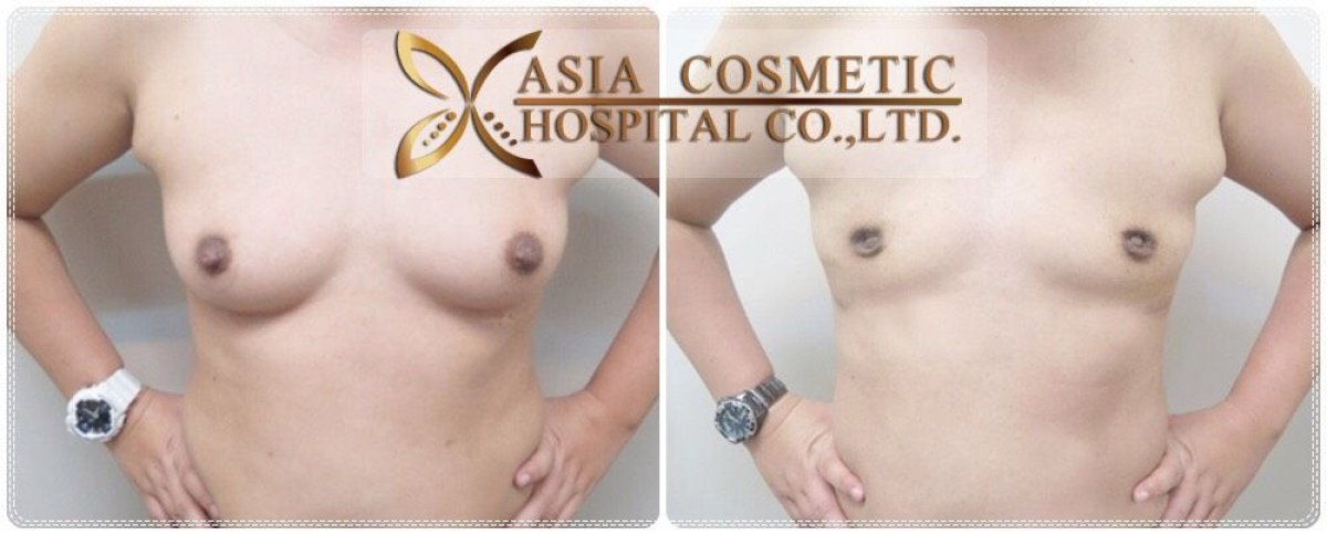 Before and after breast implant removal results at Asia Cosmetic Hospital, natural chest contour