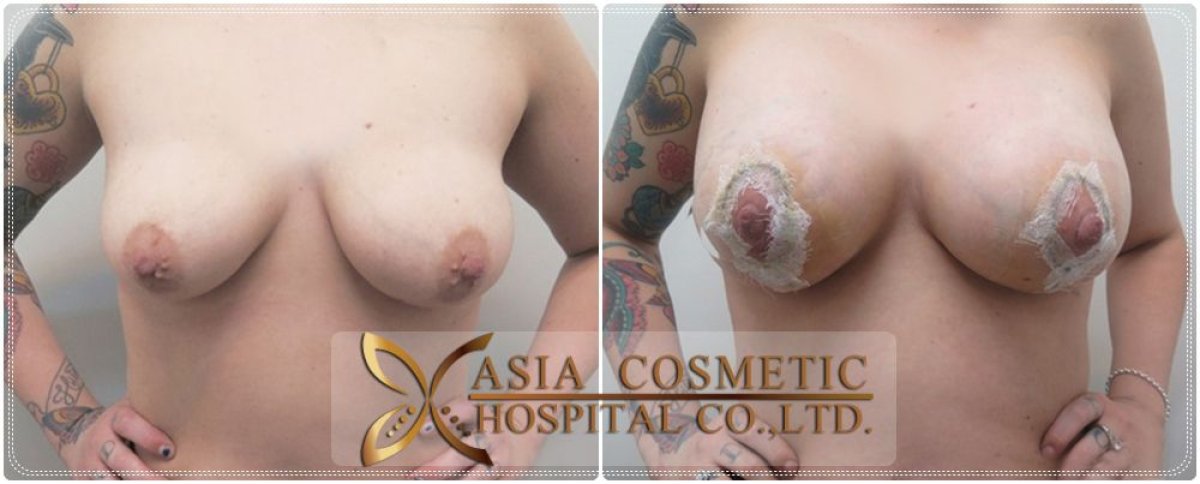 Before and after breast implant removal results at Asia Cosmetic Hospital, improved breast contour