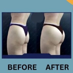Resultados antes y después de Brazilian Butt Lift en ID Clinic Bangkok, glúteos realzados