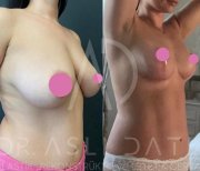 Vorher-nachher-Ergebnis Brustverkleinerung bei Liv Hospital Ulus, sichtbare Konturverbesserung