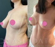 Vorher-nachher-Ergebnis Brustverkleinerung bei Liv Hospital Ulus, sichtbare Konturverbesserung