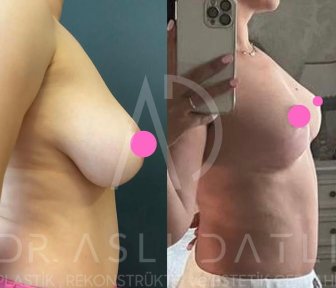 Vorher-nachher-Ergebnis Brustverkleinerung bei Liv Hospital Ulus, verbesserte Kontur