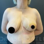Vorher-nachher-Ergebnis Brustverkleinerung bei Liv Hospital Ulus, verbesserte Kontur