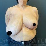 Vorher-nachher-Ergebnis Brustverkleinerung bei Liv Hospital Ulus, sichtbare Verbesserung