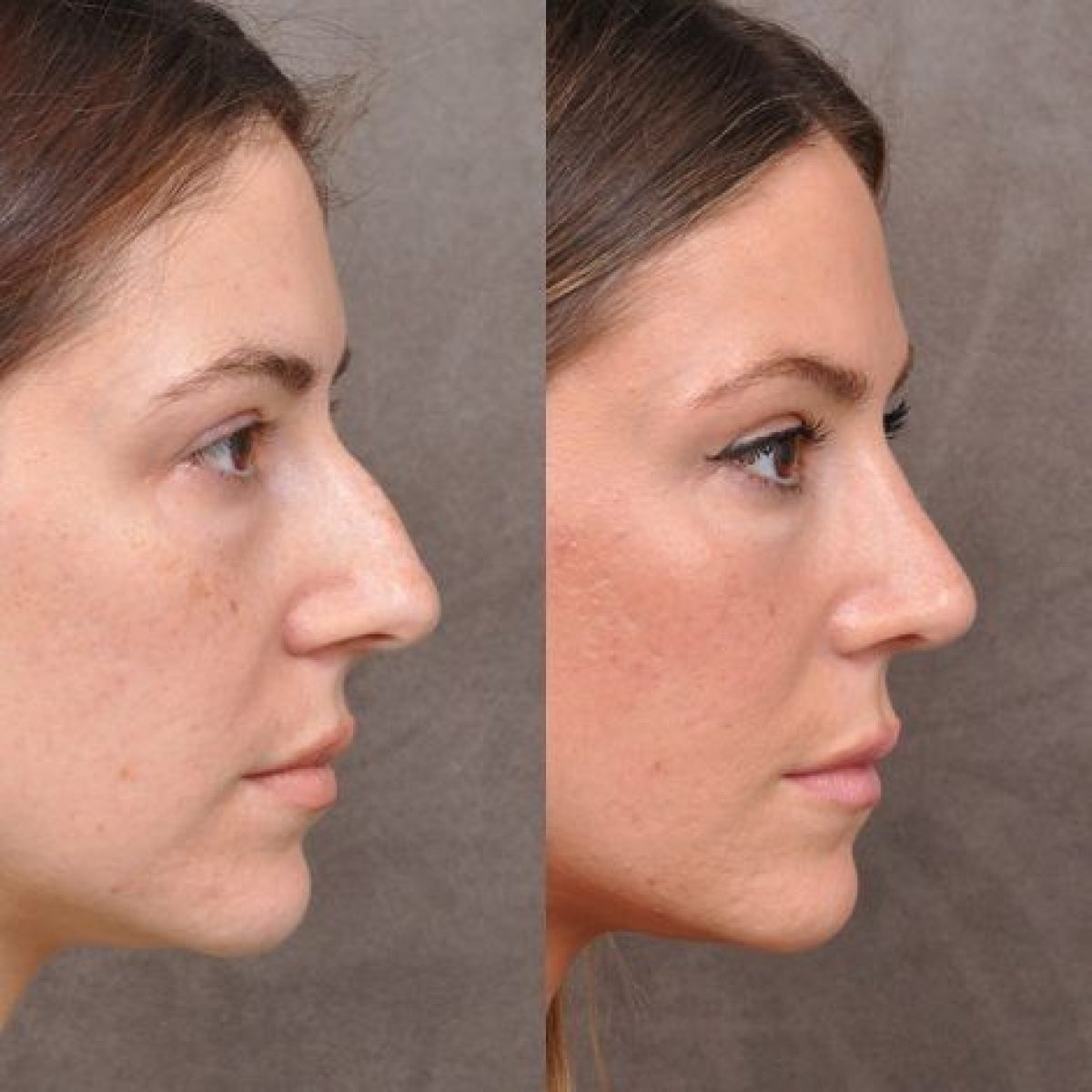 Résultats avant/après rhinoplastie à la clinique Veselibu, profil du nez amélioré
