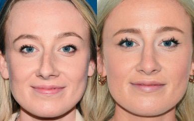Résultats avant/après rhinoplastie à la clinique Veselibu, remodelage nasal naturel